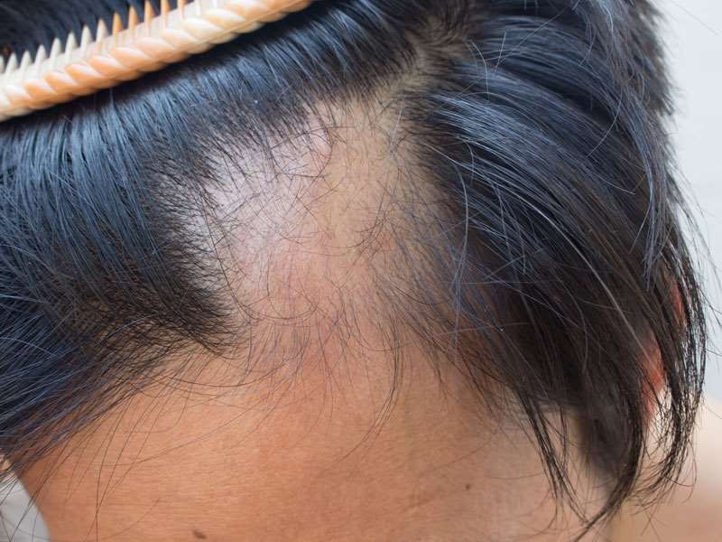 causas da queda de cabelo hereditaria