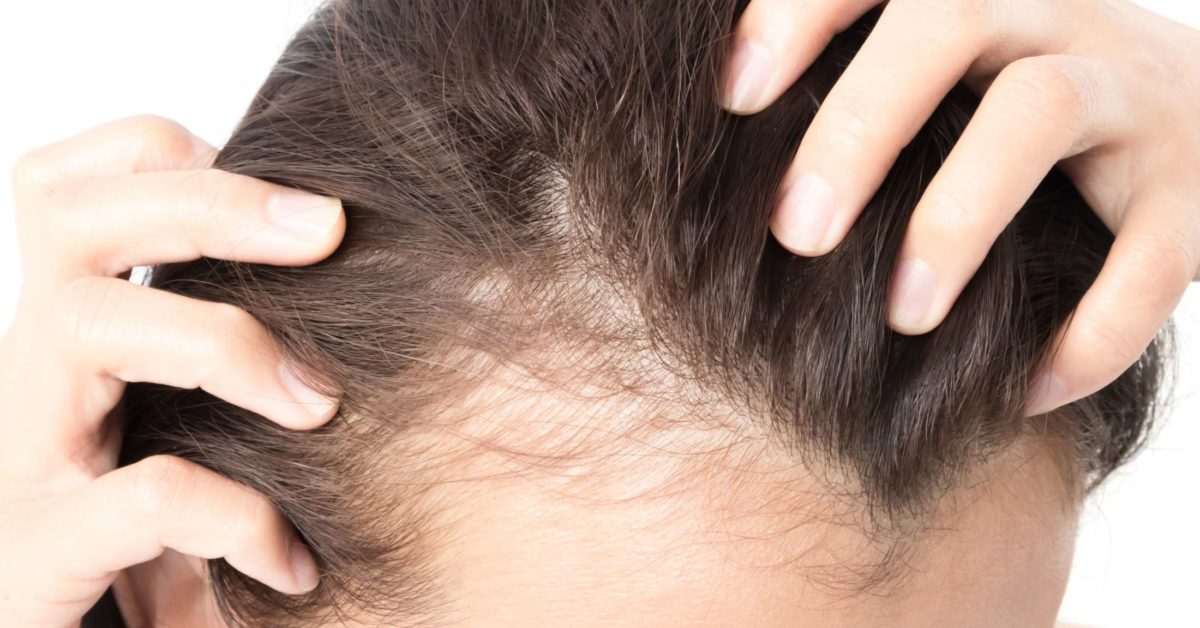 como prevenir a queda de cabelo