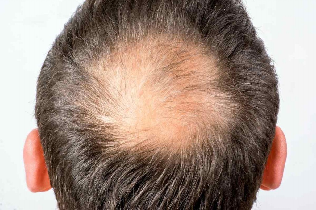 o que e alopecia