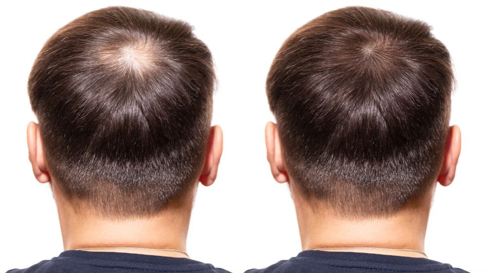 como prevenir a queda de cabelo