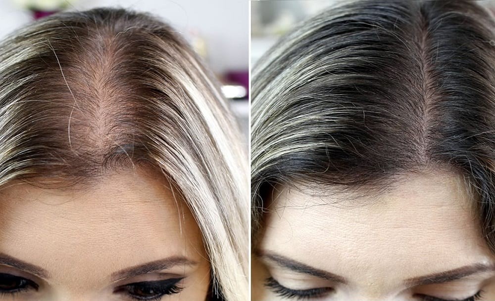 prevenir a queda de cabelo