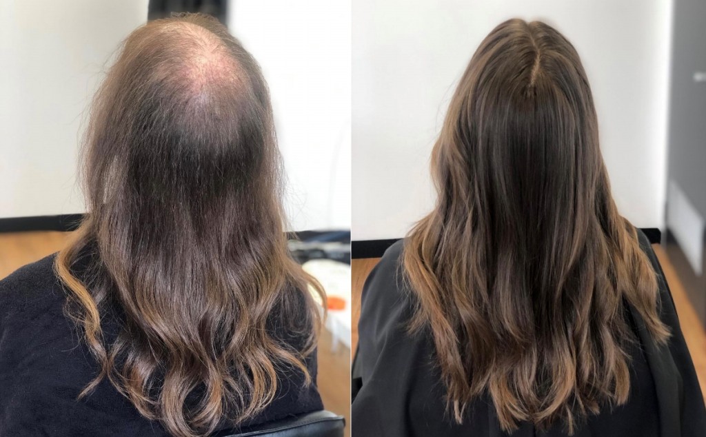 tratamento natural para acabar com a perda de cabelo