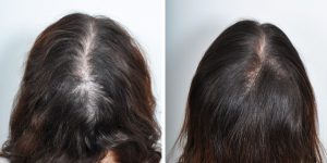 tratamento para acabar com a perda de cabelo