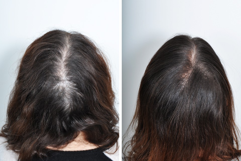 tratamento para acabar com a perda de cabelo